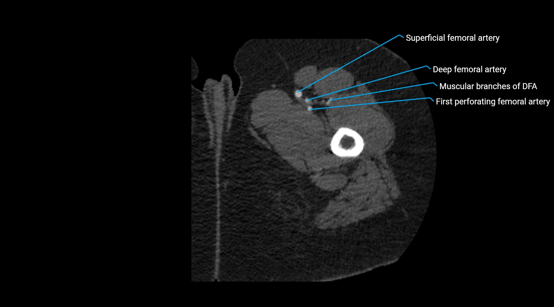 CTA lower limb cross sectional anatomy labelled image _84.webp